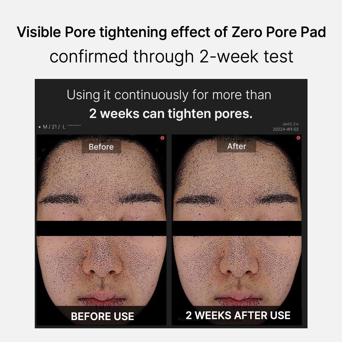 Mirco Pore Pads (AHA + BHA) |Acne