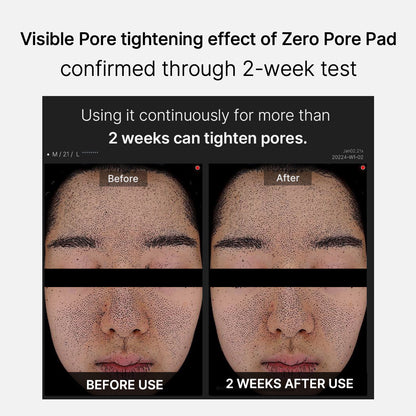 Mirco Pore Pads (AHA + BHA) |Acne