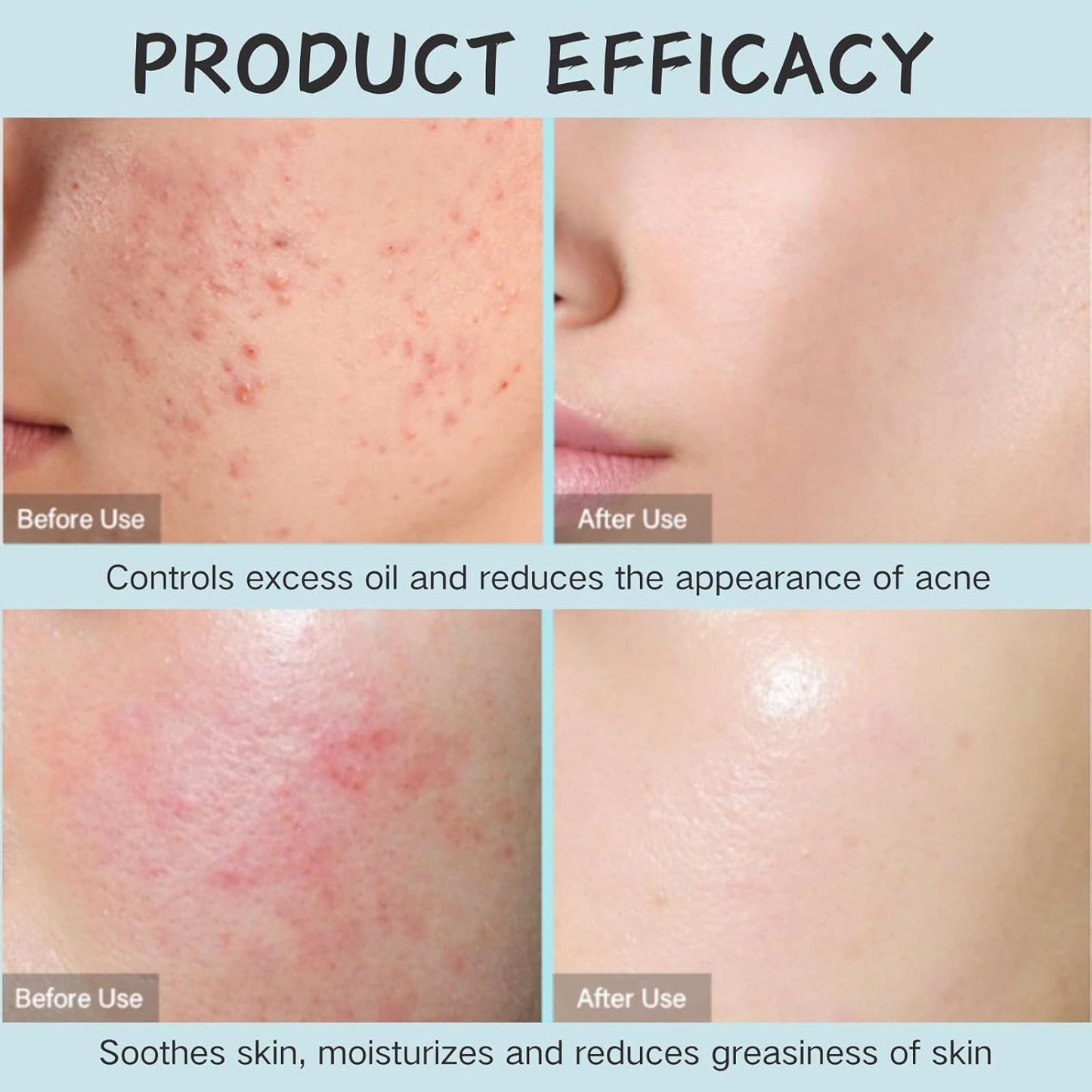 Tea Tree Salicylic Acid Oil Control Acne Removal Set