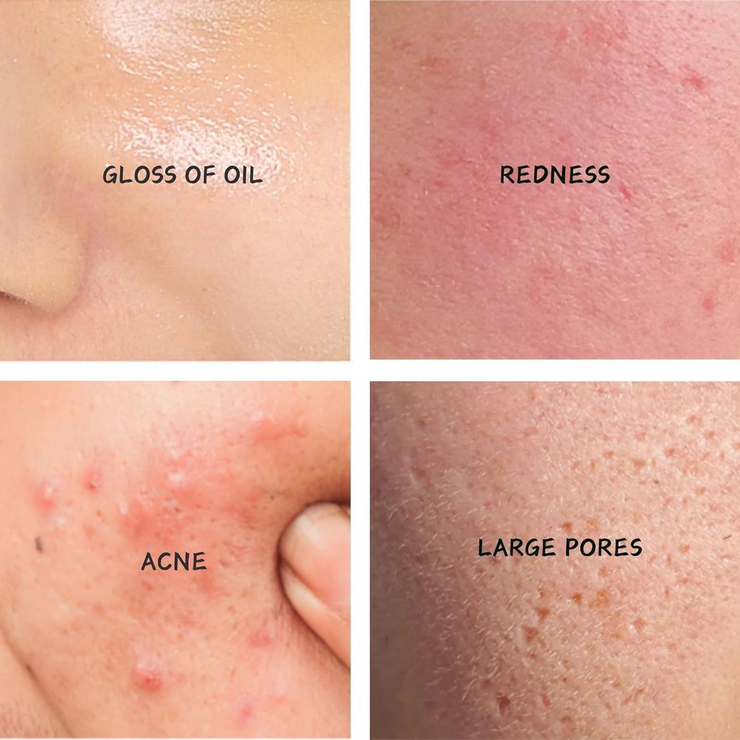 Tea Tree Salicylic Acid Oil Control Acne Removal Set