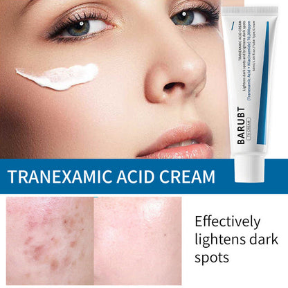 TX Tranexamic Acid CREAM | Skin freckle Cream, Blemishes, Anti