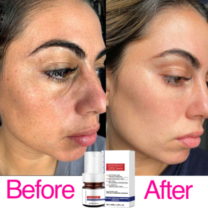 Vitamin C Whitening Freckles Face Cream Remove Melasma Dark Spots Lighten Melani