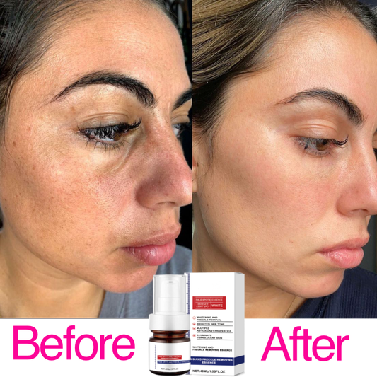 Vitamin C Whitening Freckles Face Cream Remove Melasma Dark Spots Lighten Melani