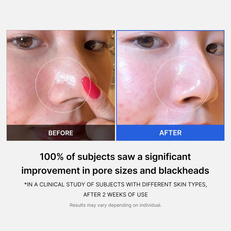 Mirco Pore Pads (AHA + BHA) |Acne