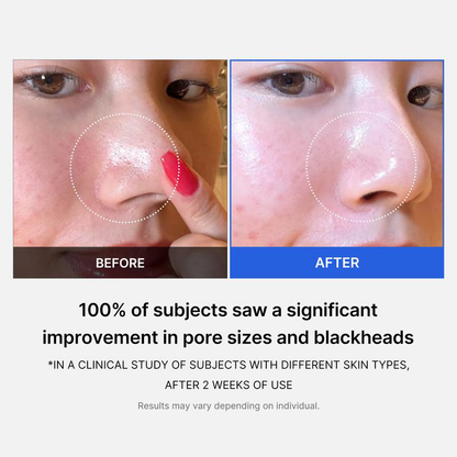 Mirco Pore Pads (AHA + BHA) |Acne
